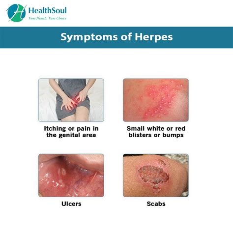 Signs of Herpes on the Penis